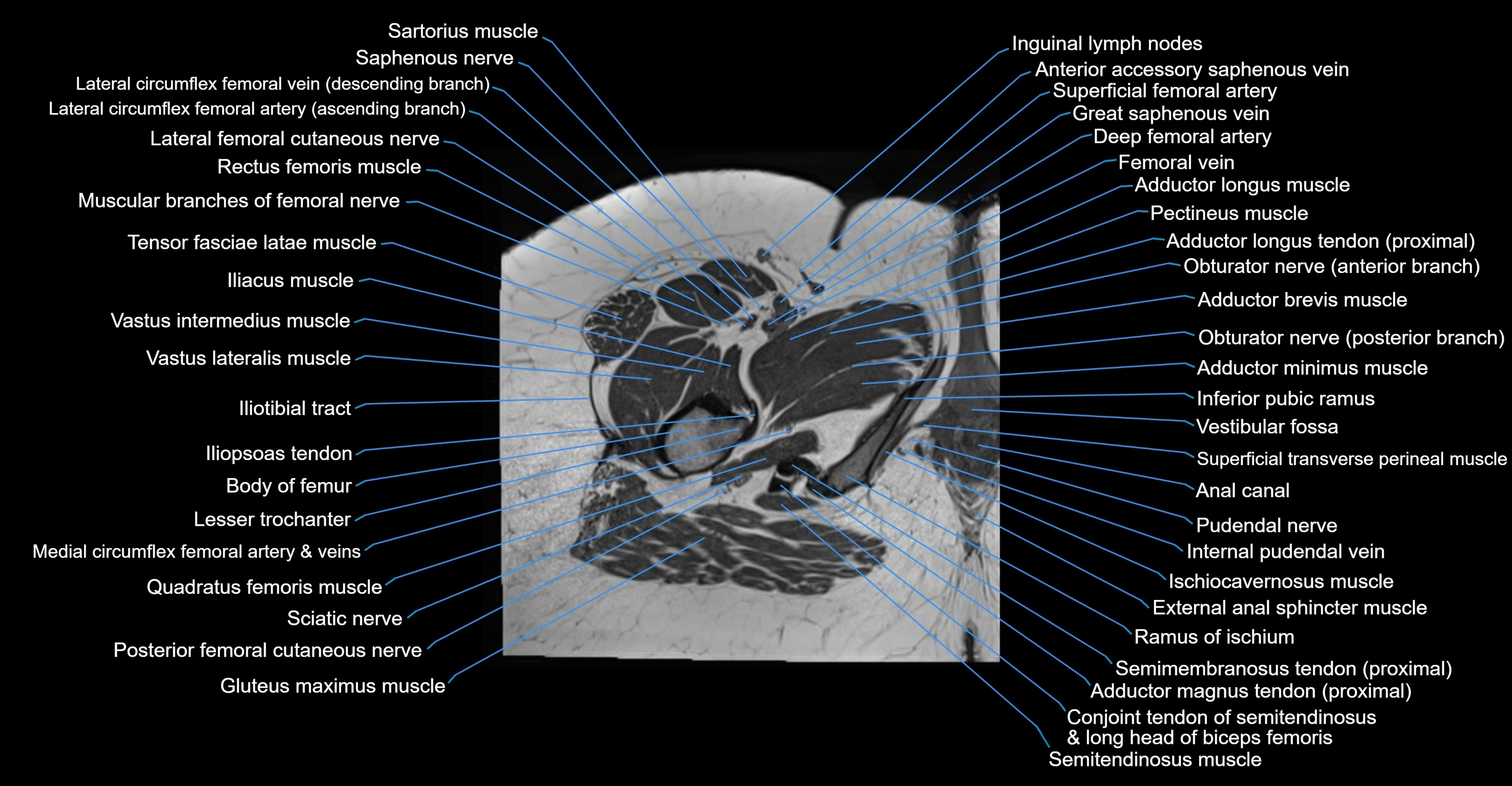 MRI hip axial cross sectional anatomy 3T 3D  radiology  anatomy image-img-00001-00066.webp